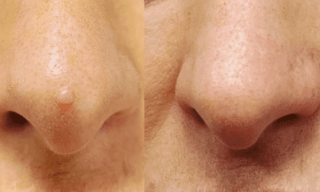 Cosmetic Mole Removal In Brisbane No Scar No Stitches.